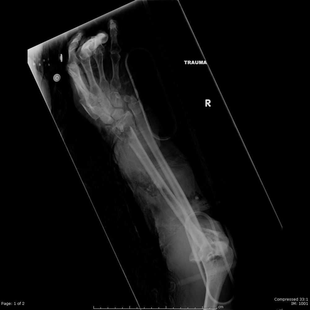 Distal Radius Fractures Trauma Orthobullets